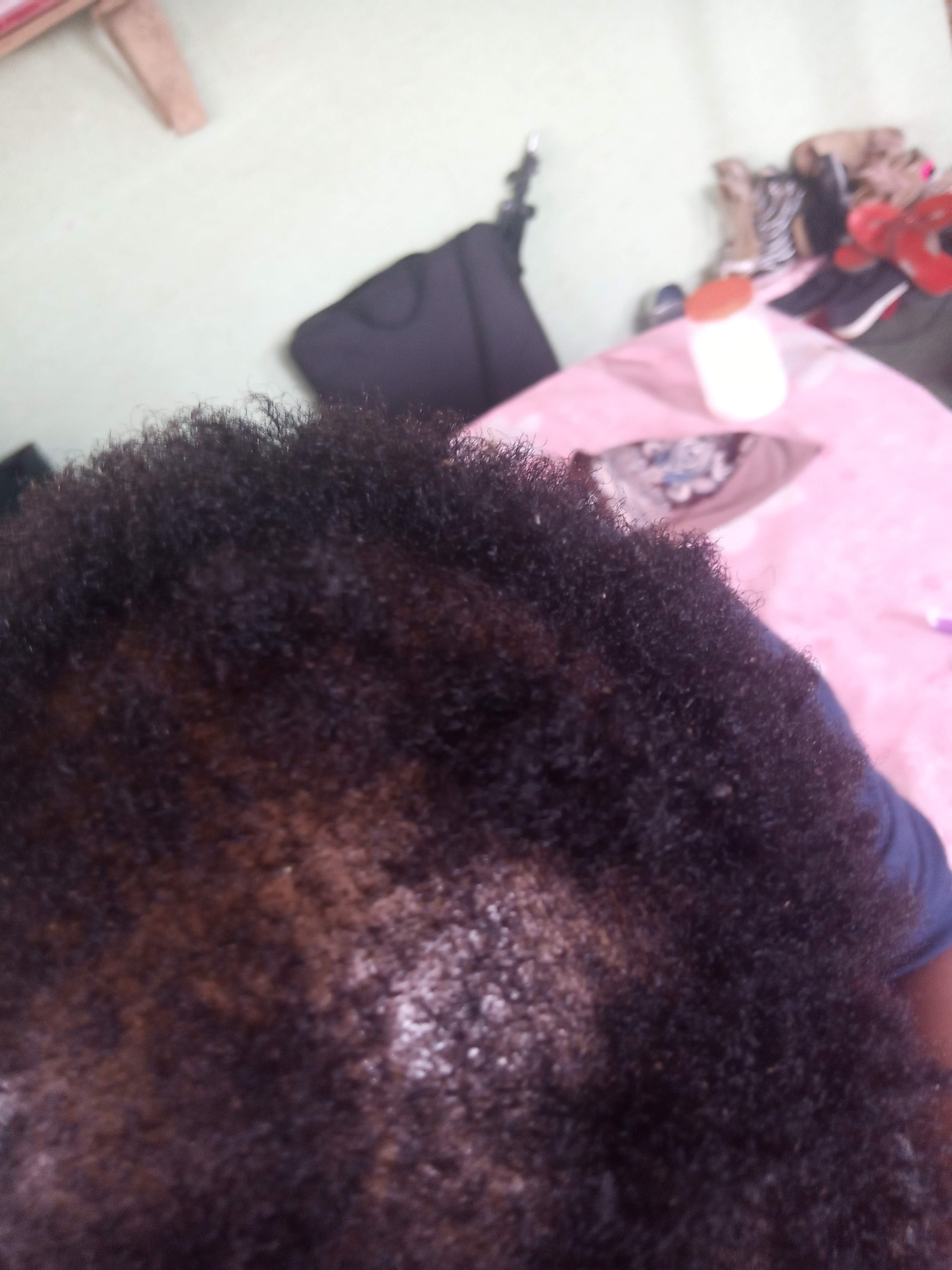 Close-up of a dry, flaky scalp needing treatment